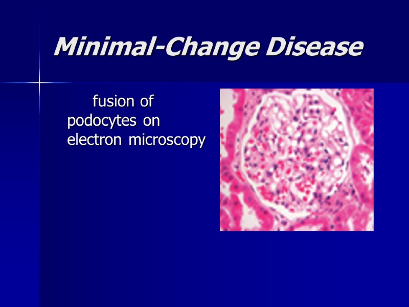 Minimal-Change Disease    fusion of podocytes on electron microscopy